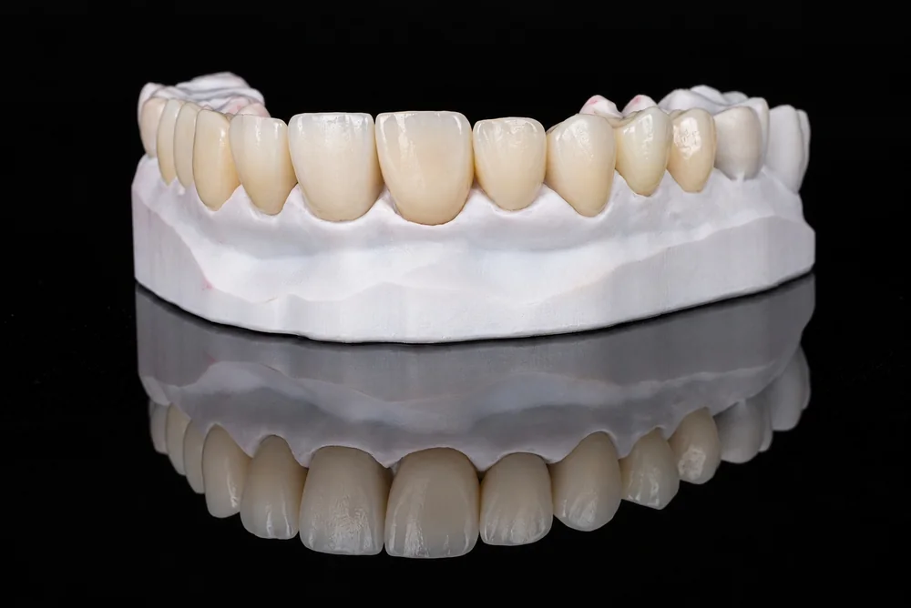 Anterior crowns on a model